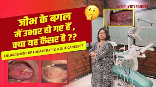 जीभ के बगल में उभार हो गए हैं क्या यह कैंसर है  Enlargement of foliate papillae Is it cancer [upl. by Poland43]