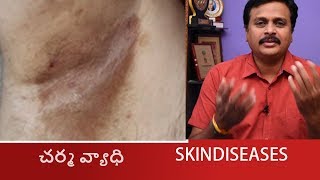 HOW TO SOLVE ERYTHRASMA SKIN DISEASES IN TELUGU CORYNEBACTERIUMHOMEOPATHIC TREATMENT WAKEUP [upl. by Alleusnoc]