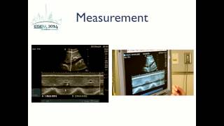 Inferior Vena Cava Ultrasound [upl. by Dewhurst]