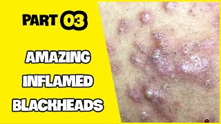 Suri Series 01 AMAZING INFLAMED BLACKHEADS POPPING  PART 3 [upl. by Nilla]