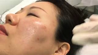 Brown Spot Removal with Electrodessication [upl. by Higinbotham]