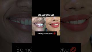 Sorriso gengival beauty skincare botox lábios estetica belezaquetransforma [upl. by Streeto]