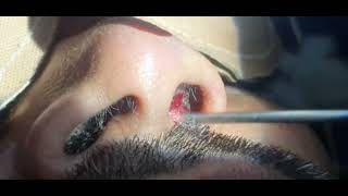 Nose abscess  Nose furuncle  Incision and drainage  Dr Hitesh Patel [upl. by Amrak]