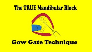 Gow Gate mandibular block [upl. by Hyacinthie]