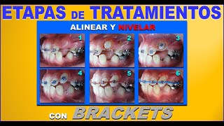 FASES O ETAPAS DE LOS TRATAMIENTOS DE ORTODONCIA CON BRACKETS [upl. by Eerac]