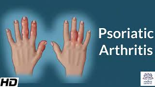 Psoriatic Arthritis Causes Signs and Symptoms Diagnosis and Treatment [upl. by Wei]