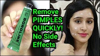 Remove PIMPLES amp ACNE IN 3 DAYS  NATURAL amp EASY METHOD [upl. by Moran]