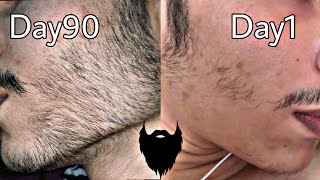 Minoxidil beard journey  3 months INSANE results [upl. by Harmon]