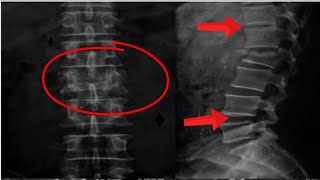 إزاي تقرأ أشعة الفقرات القطنية  How To read Xray of Lumbosacral Spine [upl. by Johnathon]