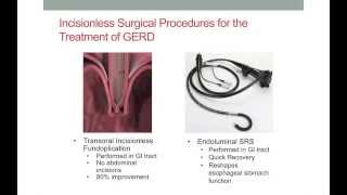 Surgical Treatment of GERD [upl. by Anaitsirc888]