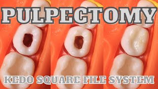 Pulpectomy 🟢 mandibular molar ⚪️ access opening 🟡 cmp 🔵 obturation [upl. by Friend]