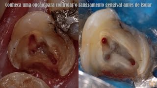 Conheça Uma Opção Para Controlar O Sangramento Gengival Antes De Isolar [upl. by Enelahs]