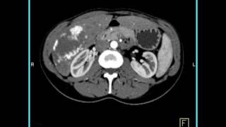 Abdomen Liver Cavernous Hemangioma of the Liver1 of 9 [upl. by Cresida]