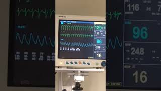 Taquicardia Supraventricular  Prácticas De Enfermería  Urgencias  enfermeria [upl. by Meagher521]