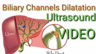 INTRA HEPATIC BILIARY DILATATION Ultrasound VIDEO demonstration [upl. by Ddene]