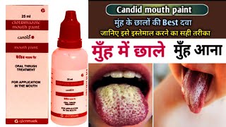 Use of candid mouth paint  How To Apply Candid Mouth Paint  Use amp Sideeffects [upl. by Nifled]