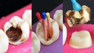 Classic Restoration Of Decayed Tooth By Root Canal And Gold Crown [upl. by Einohtna114]