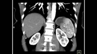 Abdomen Liver Hemangioma of the Liver3 of 8 [upl. by Evadnee]