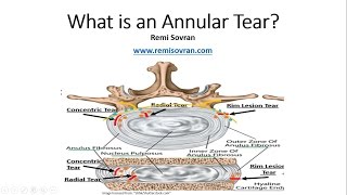 What is an Annular Tear amp Why It Is Important for You to Understand [upl. by Ayhtin]