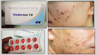 TretinIso 10mg tablet Tretin iso for Acne Pimples को रोखने की capsule tretin iso 10 mg apsule [upl. by Chadburn]