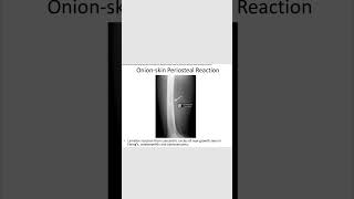 Onion skin periosteal reactionrevision neetpg inicet [upl. by Landy307]