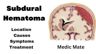 SubDural Hematoma in Hindi  Causes  Pathophysiology  clinical features  Treatment [upl. by Notelrac]