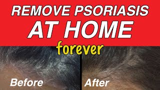 Scalp Psoriasis Removal  Descaling  Treatment [upl. by Ailahk256]