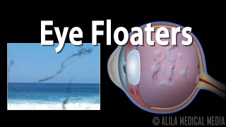 Eye Floaters and Flashes Animation [upl. by Steen11]