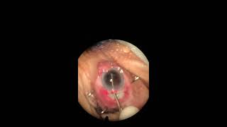 Eleventh SICS Zonular dialysis during Irrigation and aspiration [upl. by Fakieh]