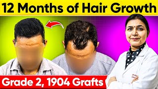 Hair Transplant Results in Agra India 1904 Grafts Norwood Grade 2  Hair Transplant Cost [upl. by Louisette87]