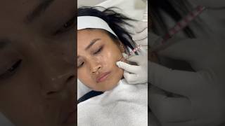 Best Botox treatment for face in India [upl. by Valera]