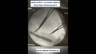 urethral stricture New successful application of Paclitaxel Dextran balloon balloonurethroplasty [upl. by Nilrem847]