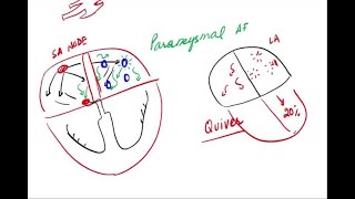 Atrial Fibrillation  Pathophysiology and Clinical [upl. by Eldon]