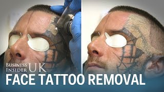 Watch This Man Have His Face Tattoo Removed From Laser Surgery  Business Insider [upl. by Inalak478]