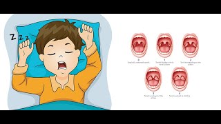 Children Sleep Apnea [upl. by Airdnaxela]