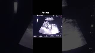 Ultrasound  Ascites Utrasound video [upl. by Eloccin]