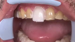 Houston Cosmetic DentistStep by step procedure for Porcelain VeneersConservative preps [upl. by Dercy]