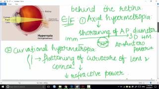 hypermetropia part 1  ophthalmology [upl. by Stevens540]