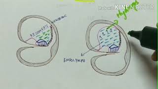 menieres disease  ENT  inner ear disease  etiology  clinical features  diagnosis  treatment [upl. by Chesney]