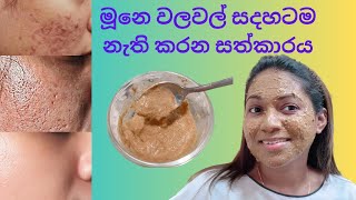 මූනෙ වලවල් වලට හොදම සත්කාරයOpen pores treatmentමුහුනෙ සිදුරු වලට සත්කාරface pack for open pores [upl. by Cockburn]