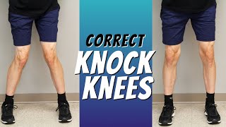 Top 5 Ways to Correct Knock Knees with Exercise Etc [upl. by Ttevy526]