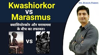 KWASHIORKOR VS MARASMUS difference  Malnutrition disease in child  Full detail in hindi [upl. by Hart]