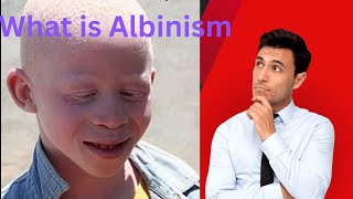 What is Albinism Albinism ratio in children Albinism definition Health Slash [upl. by Erdied]