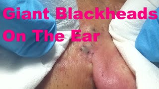 Giant Blackheads  Part I [upl. by Fuchs]