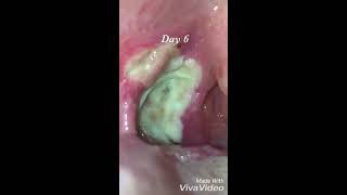 Tonsillectomy Recovery day by day [upl. by Schroer]