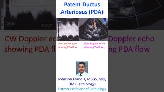 Patent Ductus Arteriosus PDA [upl. by Aaberg236]