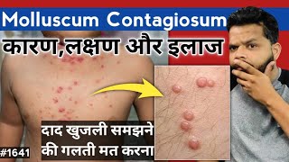 Molluscum Contagiosum Treatment In Hindi  Molluscum Contagiosum Causes And Symptoms [upl. by Benildas]