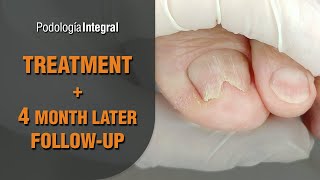 Treatment  4 months later followup podology asmr [upl. by Clarisse200]