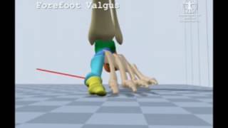 Forefoot Valgus Gait [upl. by Atla]