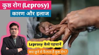 Leprosy कुष्ठ रोग Cause Symptoms and Treatment  लेप्रोसी के खतरे एवं बचाव [upl. by Carly]